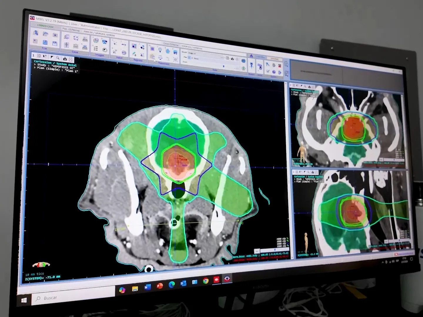 Equipo de radioterapia en acción